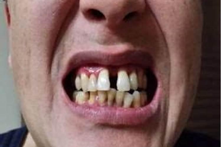 女人梦见自己掉了好几个牙齿是什么原因