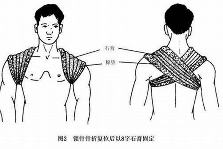 锁骨骨折八字绷带多久可以侧身睡觉