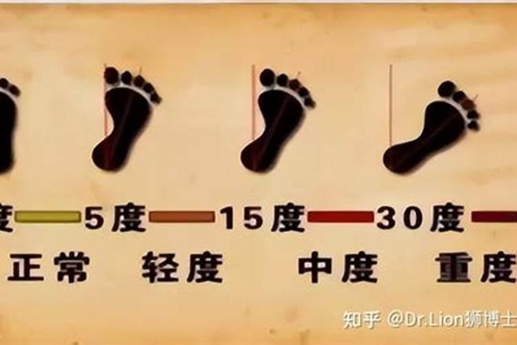 外八字走路是怎么形成的