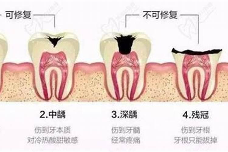 周公解梦牙齿腐蚀烂了